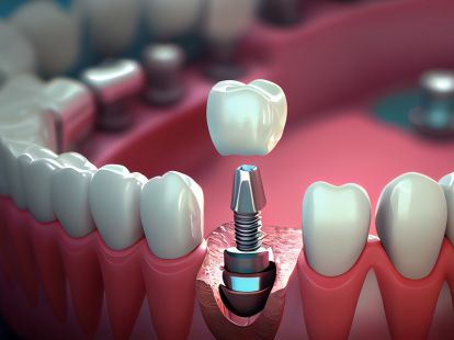 Dental implantation in Barcelona - Ref: 11942 photo 1