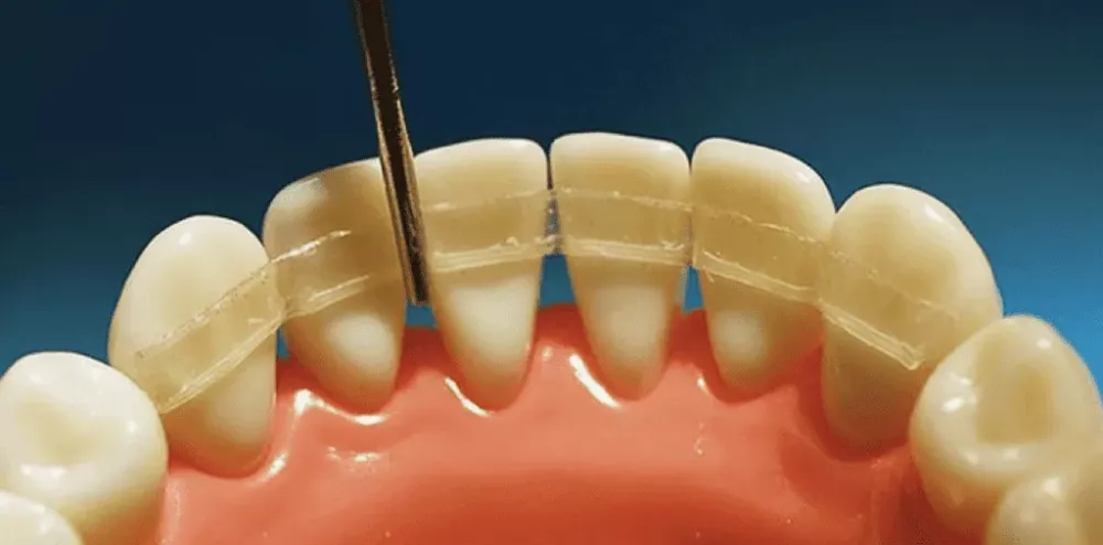 Splinting of teeth - Ref: 11956 photo 1