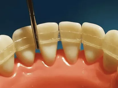 Splinting of teeth - Ref: 11956 photo 1